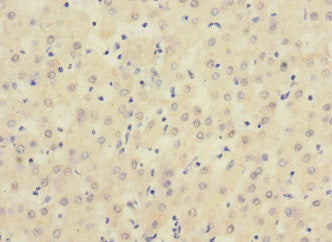 Immunohistochemistry of paraffin-embedded human liver cancer using SIGIRR Antibody at dilution of 1:100Rabbit anti-Human SIGIRR Polyclonal Antibody