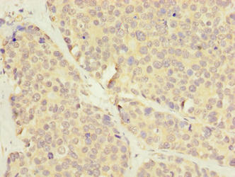 Immunohistochemistry of paraffin-embedded human gastric cancer using the antibody at dilution of 1:100