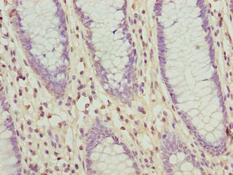 Immunohistochemistry of paraffin-embedded human colon cancer using SLC30A6 Antibody at dilution of 1:100Rabbit anti-Human SLC30A6 Polyclonal Antibody