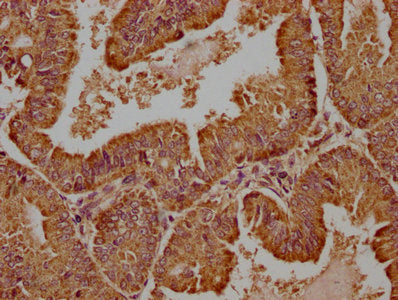 IHC image of WDR73 Antibody diluted at 1:100 and staining in paraffin-embedded human endometrial cancer performed on a Leica BondTM system. After dewaxing and hydration, antigen retrieval was mediated by high pressure in a citrate buffer (pH 6.0). Section was blocked with 10% normal goat serum 30min at RT. Then primary antibody (1% BSA) was incubated at 4°C overnight. The primary is detected by a biotinylated secondary antibody and visualized using an HRP conjugated SP system.Rabbit anti-Human WDR73 Polyclonal Antibody