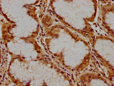 IHC image of PKN3 Antibody diluted at 1:300 and staining in paraffin-embedded human stomach cancer performed on a Leica BondTM system. After dewaxing and hydration, antigen retrieval was mediated by high pressure in a citrate buffer (pH 6.0). Section was blocked with 10% normal goat serum 30min at RT. Then primary antibody (1% BSA) was incubated at 4°C overnight. The primary is detected by a biotinylated secondary antibody and visualized using an HRP conjugated SP system.Rabbit anti-Human PKN3 Polyclonal Antibody