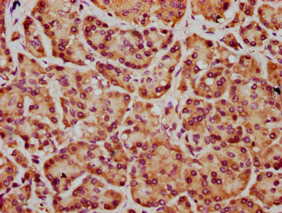 IHC image of FRMD7 Antibody diluted at 1:400 and staining in paraffin-embedded human pancreatic cancer performed on a Leica BondTM system. After dewaxing and hydration, antigen retrieval was mediated by high pressure in a citrate buffer (pH 6.0). Section was blocked with 10% normal goat serum 30min at RT. Then primary antibody (1% BSA) was incubated at 4°C overnight. The primary is detected by a biotinylated secondary antibody and visualized using an HRP conjugated SP system.Rabbit anti-Human FRMD7 Polyclonal Antibody