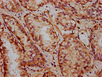 IHC image of FRMD7 Antibody diluted at 1:400 and staining in paraffin-embedded human prostate cancer performed on a Leica BondTM system. After dewaxing and hydration, antigen retrieval was mediated by high pressure in a citrate buffer (pH 6.0). Section was blocked with 10% normal goat serum 30min at RT. Then primary antibody (1% BSA) was incubated at 4°C overnight. The primary is detected by a biotinylated secondary antibody and visualized using an HRP conjugated SP system.Rabbit anti-Human FRMD7 Polyclonal Antibody