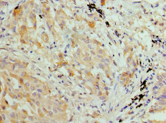 Immunohistochemistry of paraffin-embedded human lung cancer using HIST2H3A Antibody at dilution of 1: 100Rabbit anti-Human HIST2H3A Polyclonal Antibody