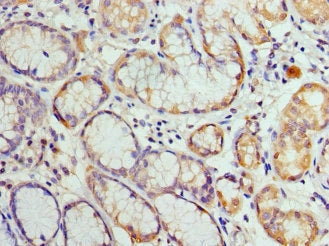 Immunohistochemistry of paraffin-embedded human gastric cancer using HIST2H3A Antibody at dilution of 1: 100Rabbit anti-Human HIST2H3A Polyclonal Antibody