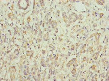 Immunohistochemistry of paraffin-embedded human pancreatic cancer using EIF3M Antibody at dilution of 1:100Rabbit anti-Human EIF3M Polyclonal Antibody