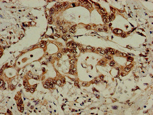 Immunohistochemistry of paraffin-embedded human pancreatic cancer using EIF3M Antibody at dilution of 1:100Rabbit anti-Human EIF3M Polyclonal Antibody