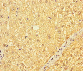 Immunohistochemistry of paraffin-embedded human liver cancer using CATSPER4 Antibody at dilution of 1:100Rabbit anti-Human CATSPER4 Polyclonal Antibody