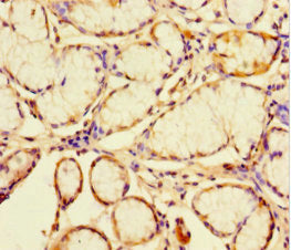 Immunohistochemistry of paraffin-embedded human gastric cancer using CATSPER4 Antibody at dilution of 1:100Rabbit anti-Human CATSPER4 Polyclonal Antibody