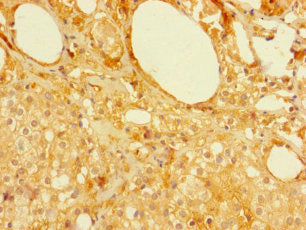 Immunohistochemistry of paraffin-embedded human prostate cancer using MFSD5 Antibody at dilution of 1:100