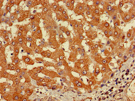 Immunohistochemistry of paraffin-embedded human liver cancer using the antibody at dilution of 1:100Rabbit anti-Human CYP20A1 Polyclonal Antibody