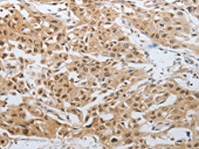 The image on the left is immunohistochemistry of paraffin-embedded Human lung cancer tissue using DNAJC7 Antibody(DNAJC7 Antibody) at dilution 1/25, on the right is treated with fusion protein. (Original magnification: ×200)Rabbit anti-Human DNAJC7 Polyclonal Antibody