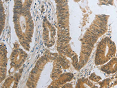 The image on the left is immunohistochemistry of paraffin-embedded Human colon cancer tissue using the antibody Antibody) at dilution 1/25, on the right is treated with fusion protein. (Original magnification: ×200)Rabbit anti-Human DNAJC7 Polyclonal Antibody