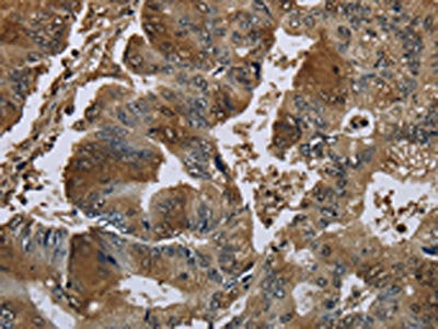The image on the left is immunohistochemistry of paraffin-embedded Human colon cancer tissue using GSTO1 Antibody(GSTO1 Antibody) at dilution 1/60, on the right is treated with fusion protein. (Original magnification: ×200)Rabbit anti-Human GSTO1 Polyclonal Antibody
