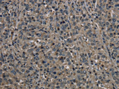 The image on the left is immunohistochemistry of paraffin-embedded Human liver cancer tissue using the antibody Antibody) at dilution 1/60, on the right is treated with fusion protein. (Original magnification: ×200)Rabbit anti-Human GSTO1 Polyclonal Antibody