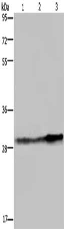 Gel: 8%SDS-PAGE, Lysate: 40 μg, Lane 1-3: Human hepatocellular carcinoma tissue, Hela cells, human fetal liver tissue, Primary antibody: GSTO1 Antibody(GSTO1 Antibody) at dilution 1/350, Secondary antibody: Goat anti rabbit IgG at 1/8000 dilution, Exposure time: 10 secondsRabbit anti-Human GSTO1 Polyclonal Antibody