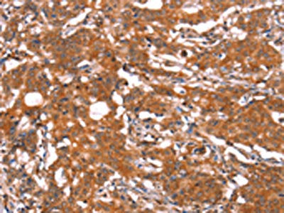 The image on the left is immunohistochemistry of paraffin-embedded Human gastric cancer tissue using FUT1 Antibody(FUT1 Antibody) at dilution 1/30, on the right is treated with synthetic peptide. (Original magnification: ×200)Rabbit anti-Human FUT1 Polyclonal Antibody