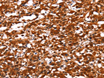 The image on the left is immunohistochemistry of paraffin-embedded Human thyroid cancer tissue using the antibody Antibody) at dilution 1/30, on the right is treated with synthetic peptide. (Original magnification: ×200)Rabbit anti-Human FUT1 Polyclonal Antibody