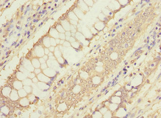 Immunohistochemistry of paraffin-embedded human colon cancer using MTHFD1L Antibody at dilution of 1:100Rabbit anti-Human MTHFD1L Polyclonal Antibody