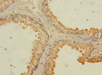 Immunohistochemistry of paraffin-embedded human prostate cancer using RASSF6 Antibody at dilution of 1:100Rabbit anti-Human RASSF6 Polyclonal Antibody