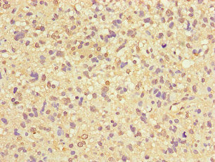 Immunohistochemistry of paraffin-embedded human glioma using ZNF365 Antibody at dilution of 1:100Rabbit anti-Human ZNF365 Polyclonal Antibody