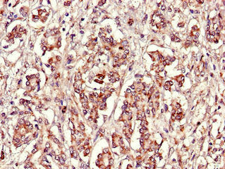 Immunohistochemistry of paraffin-embedded human pancreatic cancer using FBXL22 Antibody at dilution of 1:100Rabbit anti-Human FBXL22 Polyclonal Antibody