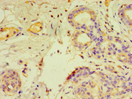 Immunohistochemistry of paraffin-embedded human breast cancer using GTF2H2C Antibody at dilution of 1:100Rabbit anti-Human GTF2H2C Polyclonal Antibody