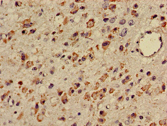 Immunohistochemistry of paraffin-embedded human glioma using TTC27 Antibody at dilution of 1:100Rabbit anti-Human TTC27 Polyclonal Antibody
