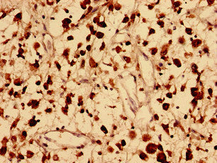 Immunohistochemistry analysis of human melanoma using the antibody at dilution of 1:100Rabbit anti-Human FAM171B Polyclonal Antibody