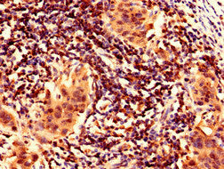 Immunohistochemistry analysis of human bladder cancer using FAM171B Antibody at dilution of 1:100Rabbit anti-Human FAM171B Polyclonal Antibody