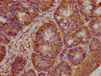 IHC image of BRAT1 Antibody diluted at 1:300 and staining in paraffin-embedded human colon cancer performed on a Leica BondTM system. After dewaxing and hydration, antigen retrieval was mediated by high pressure in a citrate buffer (pH 6.0). Section was blocked with 10% normal goat serum 30min at RT. Then primary antibody (1% BSA) was incubated at 4°C overnight. The primary is detected by a biotinylated secondary antibody and visualized using an HRP conjugated SP system.