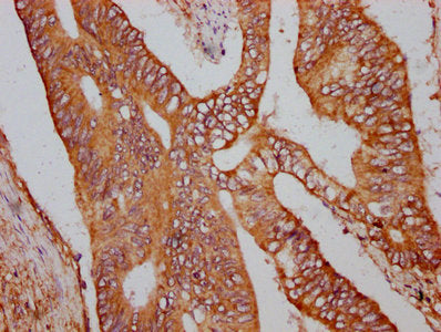 IHC image of the antibody diluted at 1:600 and staining in paraffin-embedded human colon cancer performed on a Leica BondTM system. After dewaxing and hydration, antigen retrieval was mediated by high pressure in a citrate buffer (pH 6.0). Section was blocked with 10% normal goat serum 30min at RT. Then primary antibody (1% BSA) was incubated at 4°C overnight. The primary is detected by a biotinylated secondary antibody and visualized using an HRP conjugated SP system.Rabbit anti-Human UBR3 Polyclonal Antibody