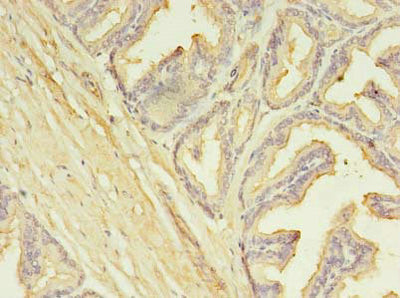 Immunohistochemistry of paraffin-embedded human prostate cancer using SLC25A25 Antibody at dilution of 1:100Rabbit anti-Human SLC25A25 Polyclonal Antibody