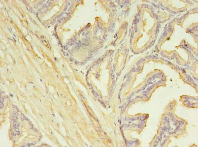 Immunohistochemistry of paraffin-embedded human prostate cancer using SLC25A25 Antibody at dilution of 1:100Rabbit anti-Human SLC25A25 Polyclonal Antibody