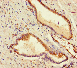 Immunohistochemistry of paraffin-embedded human prostate cancer using Adck2 Antibody at dilution of 1:100Rabbit anti-Mus musculus (Mouse) Adck2 Polyclonal Antibody