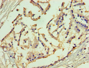 Immunohistochemistry of paraffin-embedded human prostate tissue using SLC27A4 Antibody at dilution of 1:100Rabbit anti-Human SLC27A4 Polyclonal Antibody