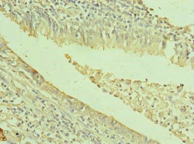 Immunohistochemistry of paraffin-embedded human lung cancer using TXNDC11 Antibody at dilution of 1:100Rabbit anti-Human TXNDC11 Polyclonal Antibody