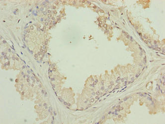 Immunohistochemistry of paraffin-embedded human prostate cancer using HACD2 Antibody at dilution of 1:100Rabbit anti-Human HACD2 Polyclonal Antibody