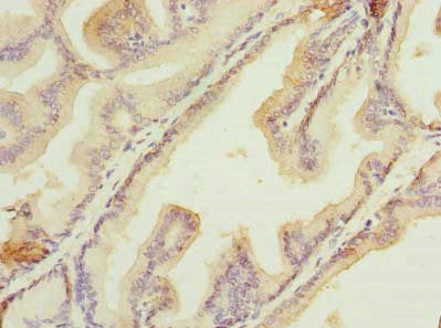 Immunohistochemistry of paraffin-embedded human prostate cancer using HSDL2 Antibody at dilution of 1:100Rabbit anti-Human HSDL2 Polyclonal Antibody