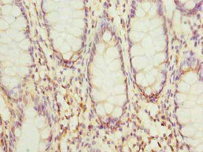 Immunohistochemistry of paraffin-embedded human colon cancer using HSDL2 Antibody at dilution of 1:100Rabbit anti-Human HSDL2 Polyclonal Antibody