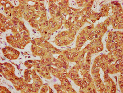 IHC image of the antibody diluted at 1:1200 and staining in paraffin-embedded human liver cancer performed on a Leica BondTM system. After dewaxing and hydration, antigen retrieval was mediated by high pressure in a citrate buffer (pH 6.0). Section was blocked with 10% normal goat serum 30min at RT. Then primary antibody (1% BSA) was incubated at 4°C overnight. The primary is detected by a biotinylated secondary antibody and visualized using an HRP conjugated SP system.Rabbit anti-Human MOB1B Polyclonal Antibody