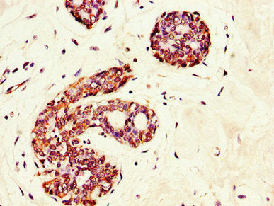 Immunohistochemistry of paraffin-embedded human breast cancer using GRAMD4 Antibody at dilution of 1:100Rabbit anti-Human GRAMD4 Polyclonal Antibody