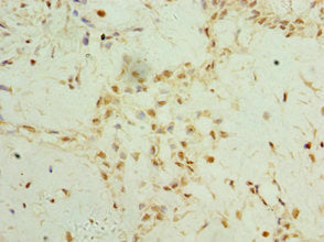 Immunohistochemistry of paraffin-embedded human breast cancer using the antibody at dilution of 1:100Rabbit anti-Human TET2 Polyclonal Antibody