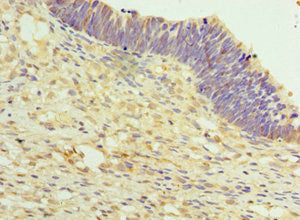 Immunohistochemistry of paraffin-embedded human ovarian cancer using TET2 Antibody at dilution of 1:100Rabbit anti-Human TET2 Polyclonal Antibody