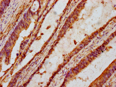 IHC image of TTI2 Antibody diluted at 1:100 and staining in paraffin-embedded human colon cancer performed on a Leica BondTM system. After dewaxing and hydration, antigen retrieval was mediated by high pressure in a citrate buffer (pH 6.0). Section was blocked with 10% normal goat serum 30min at RT. Then primary antibody (1% BSA) was incubated at 4°C overnight. The primary is detected by a biotinylated secondary antibody and visualized using an HRP conjugated SP system.Rabbit anti-Human TTI2 Polyclonal Antibody