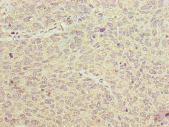 Immunohistochemistry of paraffin-embedded human cervical cancer using PGM2L1 Antibody at dilution of 1:100Rabbit anti-Human PGM2L1 Polyclonal Antibody