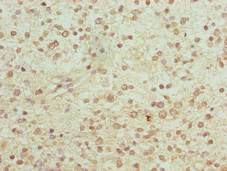 Immunohistochemistry of paraffin-embedded human glioma using PGM2L1 Antibody at dilution of 1:100Rabbit anti-Human PGM2L1 Polyclonal Antibody