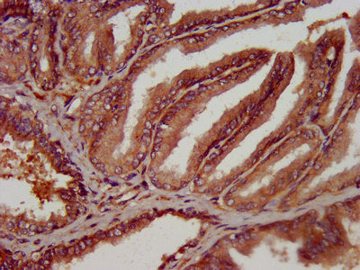IHC image of OLFM4 Antibody diluted at 1:300 and staining in paraffin-embedded human prostate tissue performed on a Leica BondTM system. After dewaxing and hydration, antigen retrieval was mediated by high pressure in a citrate buffer (pH 6.0). Section was blocked with 10% normal goat serum 30min at RT. Then primary antibody (1% BSA) was incubated at 4°C overnight. The primary is detected by a biotinylated secondary antibody and visualized using an HRP conjugated SP system.Rabbit anti-Human OLFM4 Polyclonal Antibody