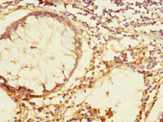 Immunohistochemistry of paraffin-embedded human colon cancer using TEX43 Antibody at dilution of 1:100Rabbit anti-Human TEX43 Polyclonal Antibody