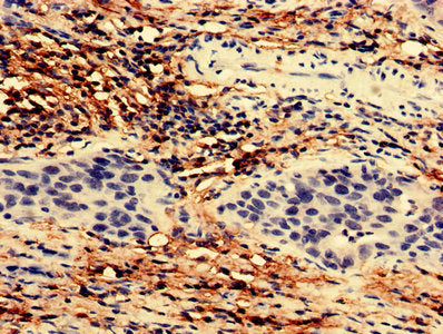 Immunohistochemistry analysis of human bladder cancer using TEX43 Antibody at dilution of 1:100Rabbit anti-Human TEX43 Polyclonal Antibody